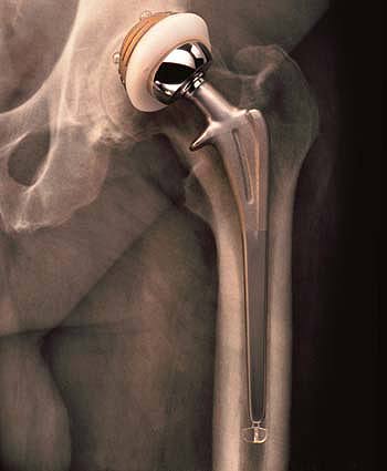 photo of Exactech artificial hip
